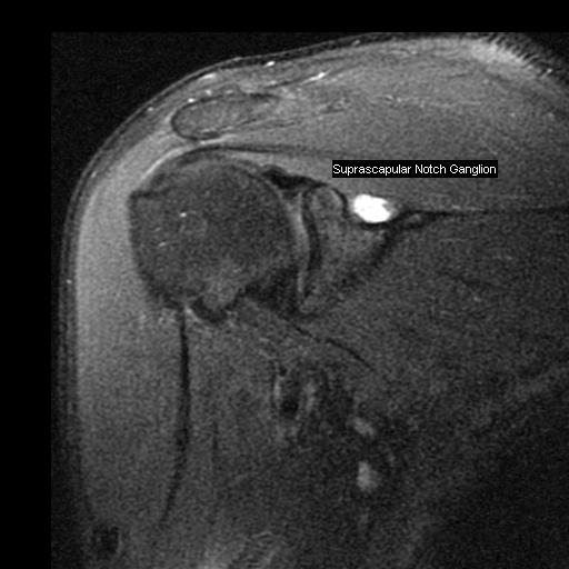 Figure 2 for case Notch ganglion cysts